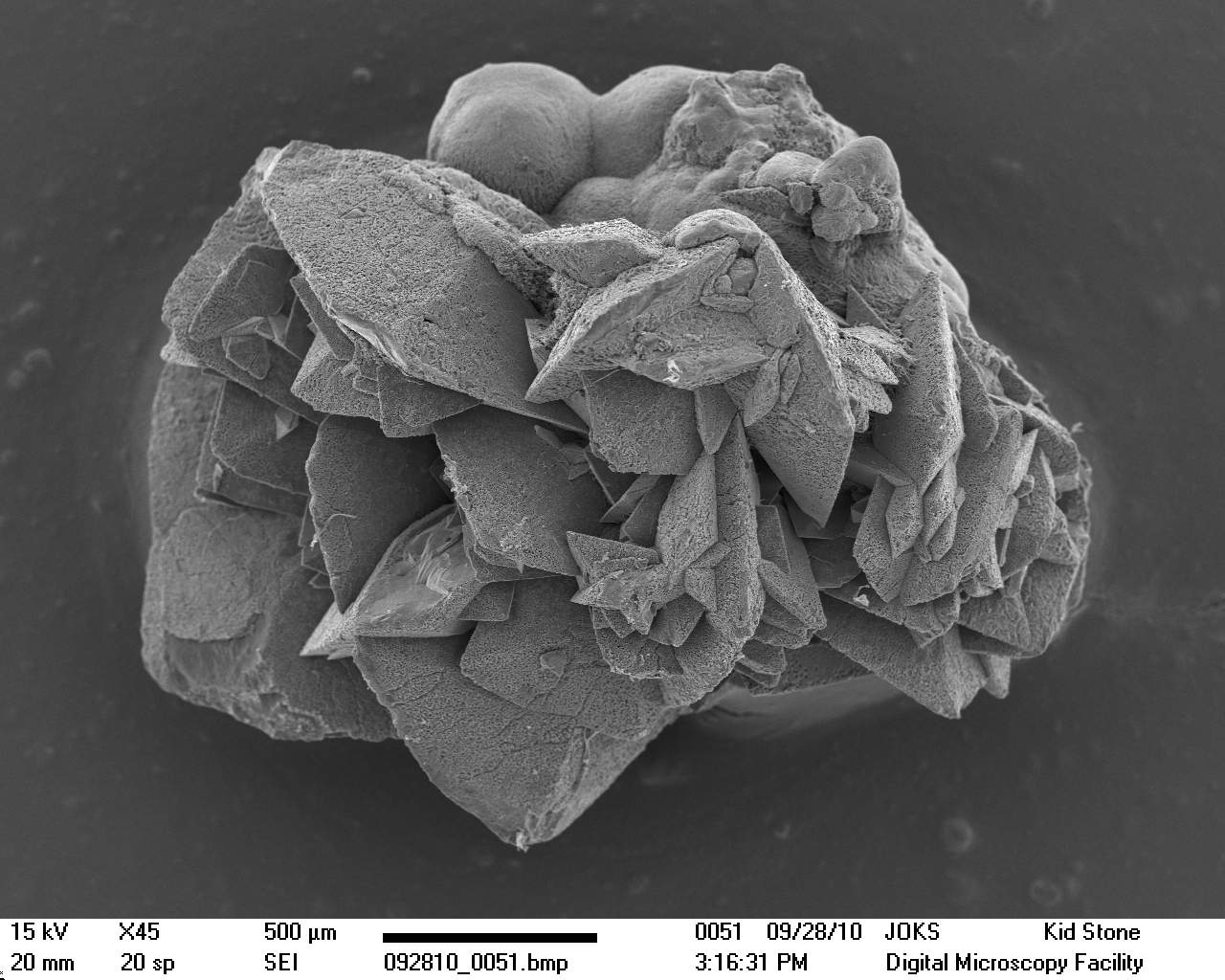 calcium oxalate stone microscope